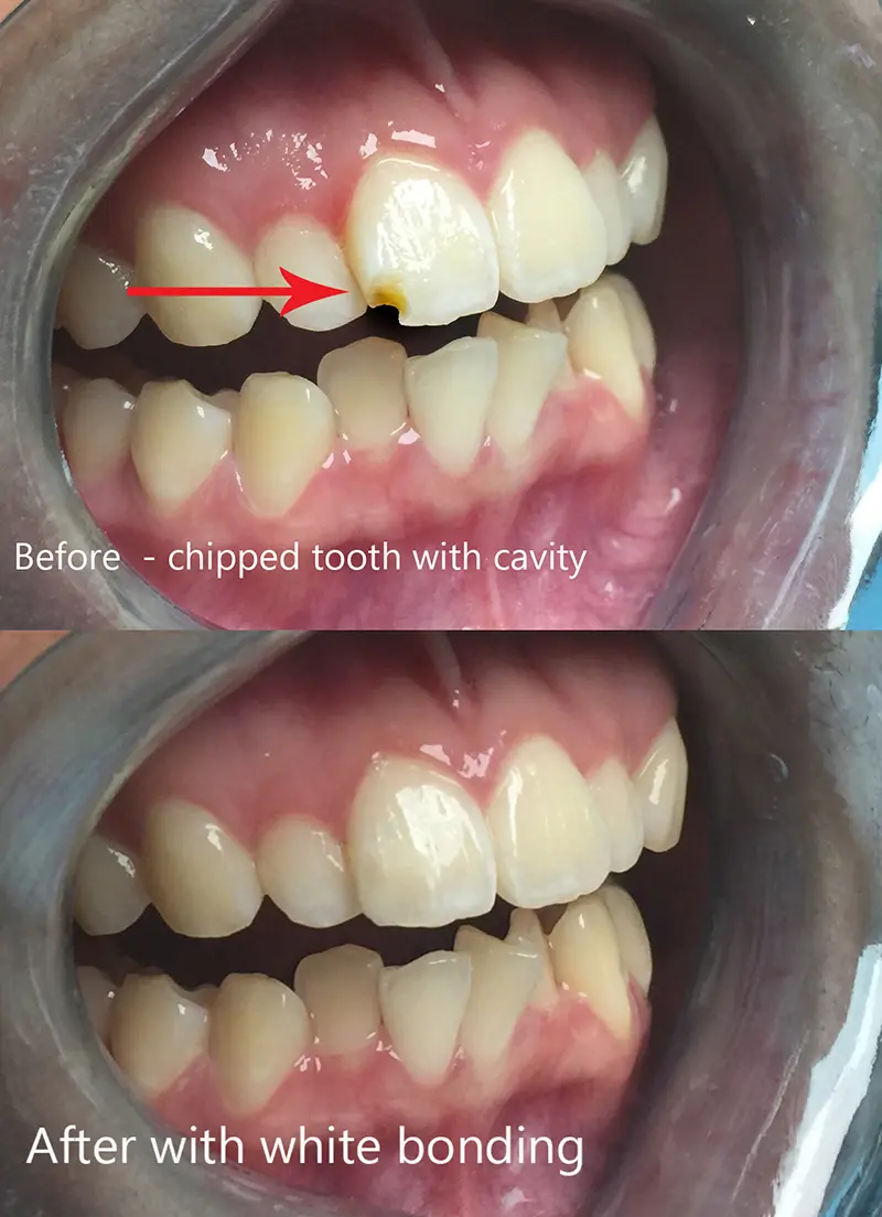 Composite Restorations & Cavity Treatment 2